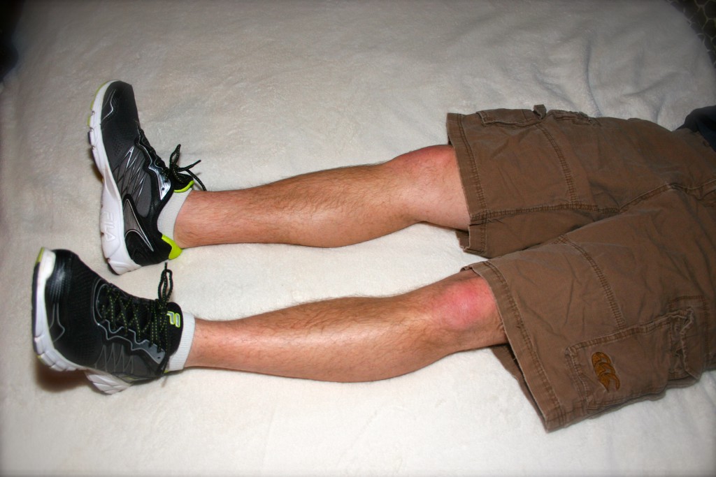 Total Hip Replacement Rehab Tips From A Physical Therapist