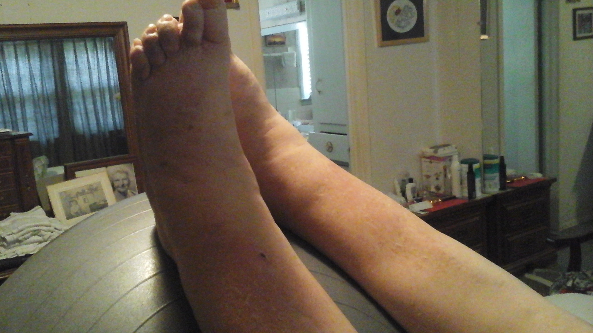 Lower leg swelling