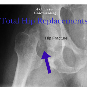 Total Hip Replacement Image