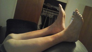 pic of foot after swelling treatment
