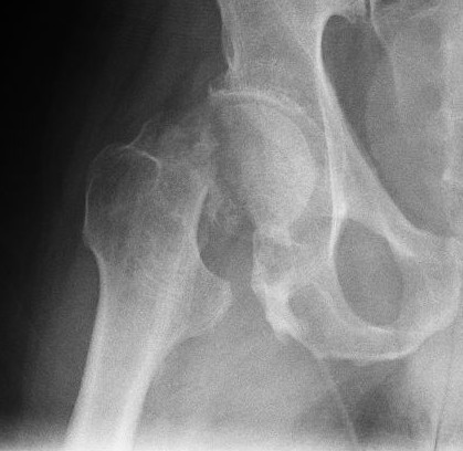 hip fracture xray image