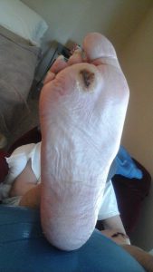 Foot Wound